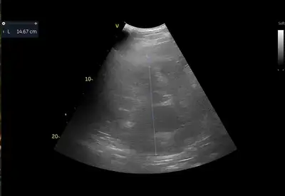 ultrasound image of tumour in abdomen