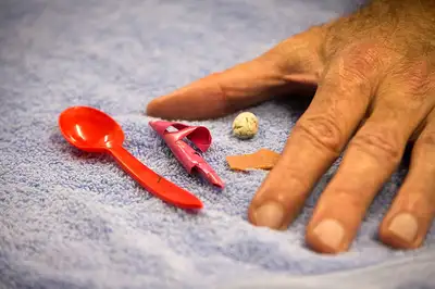 Spoon, balloon and more removed from birds stomach - image2